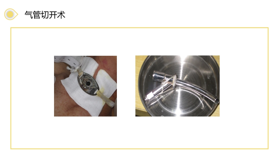 气管切开病人的护理3_第12页