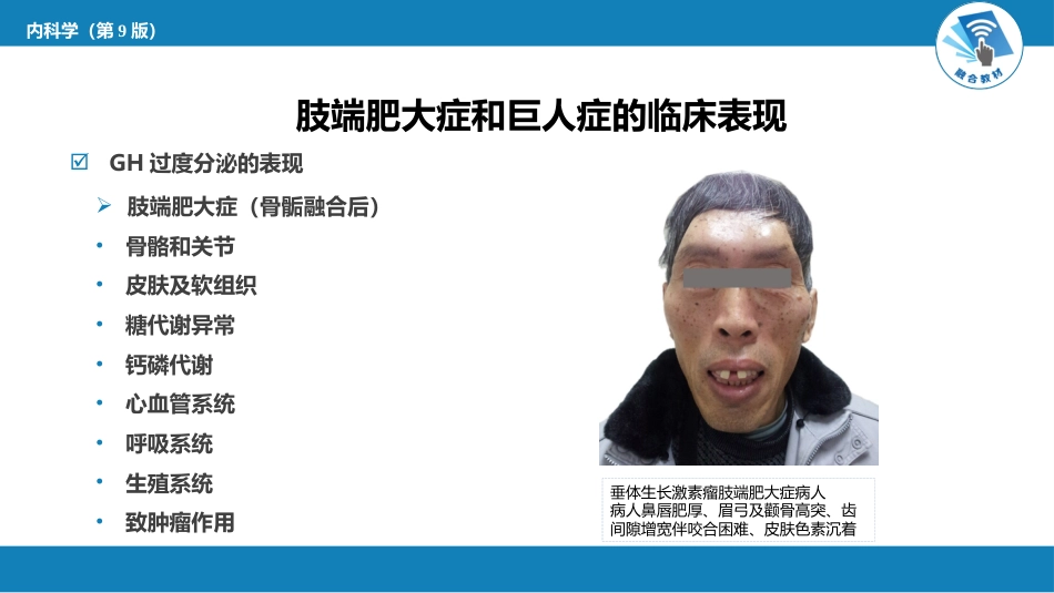 内分泌科：肢端肥大症和巨人症_第8页
