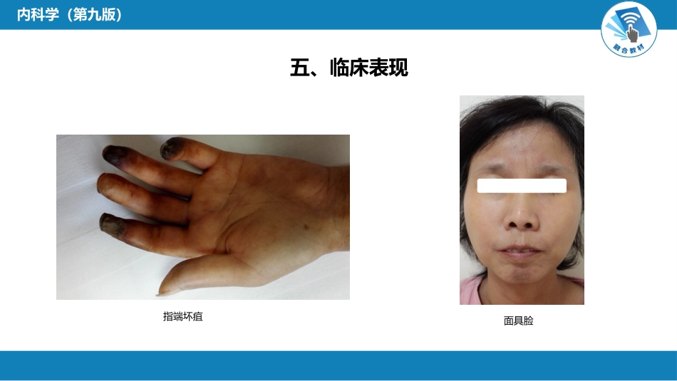 风湿免疫科：系统性硬化病_第9页