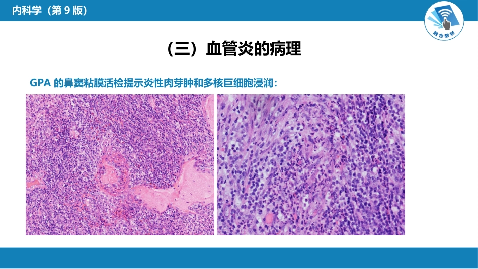 风湿免疫科：原发性血管炎_第12页