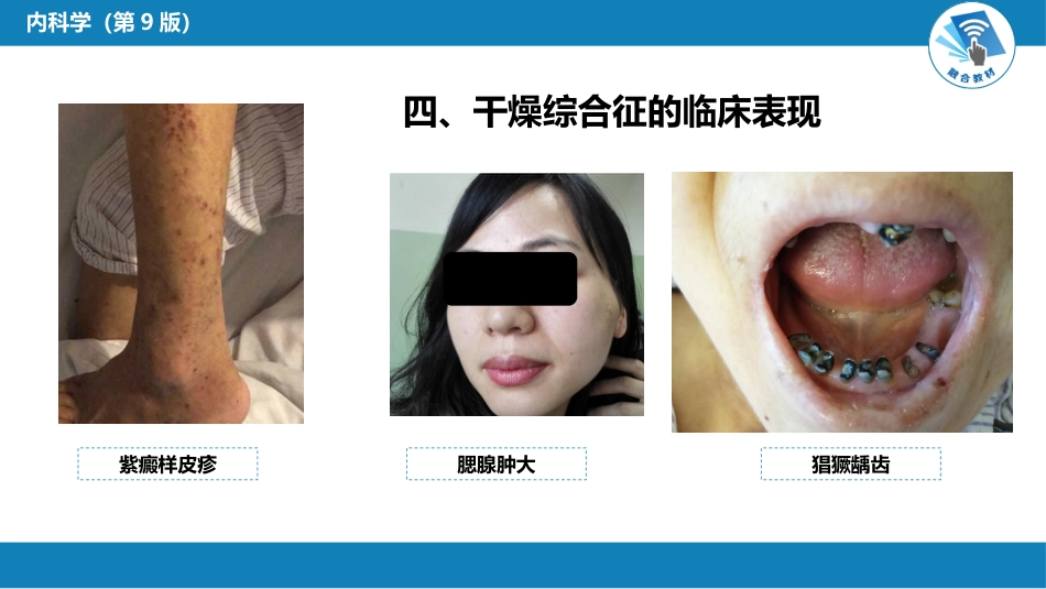 风湿免疫科：干燥综合征_第11页