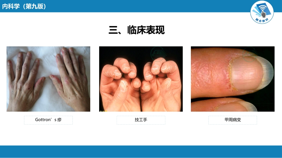 风湿免疫科：特发性炎症性肌病_第10页