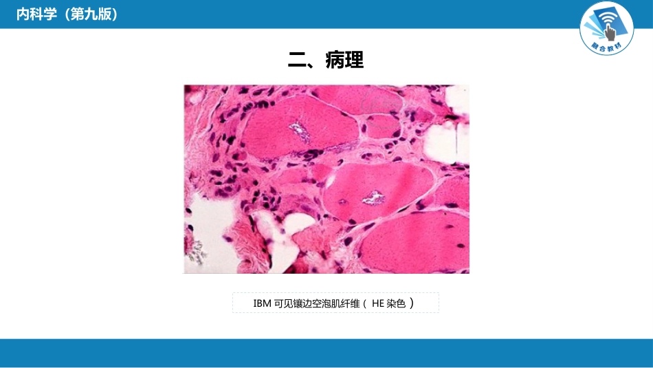 风湿免疫科：特发性炎症性肌病_第6页