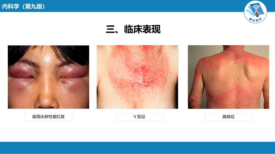 风湿免疫科：特发性炎症性肌病_第9页
