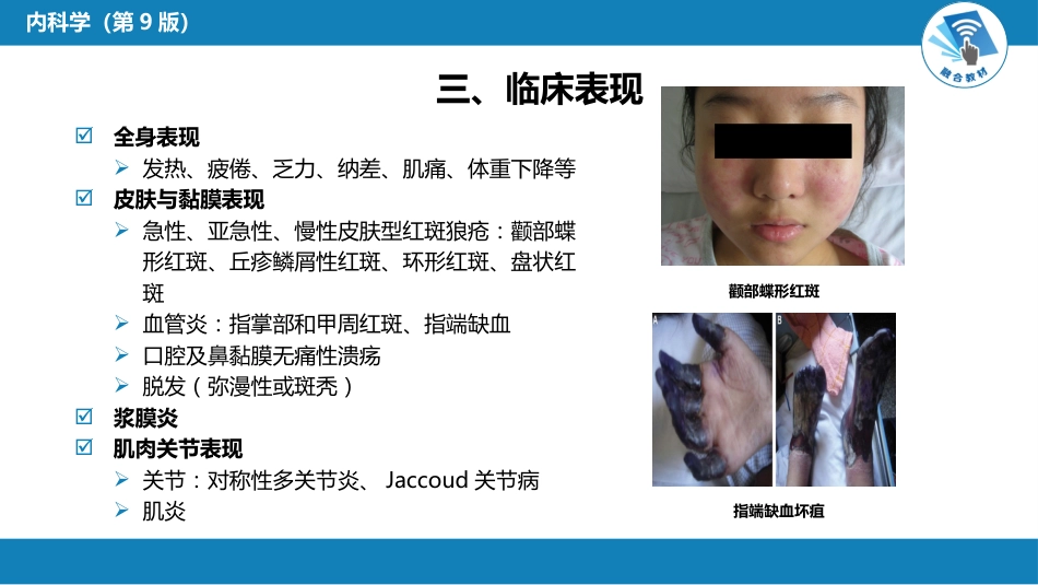 风湿免疫科：系统性红斑狼疮_第8页