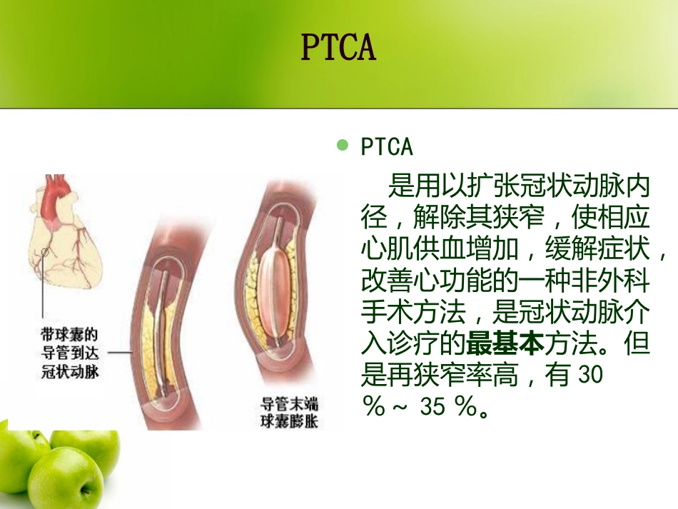 冠状动脉介入治疗及护理_第4页