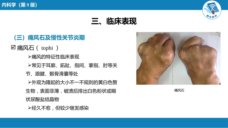 风湿免疫科：痛风_第8页