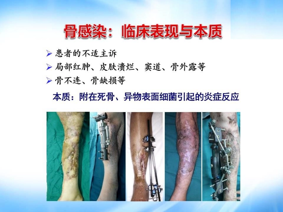 Masquelet技术治疗感染性大段骨缺损_第7页
