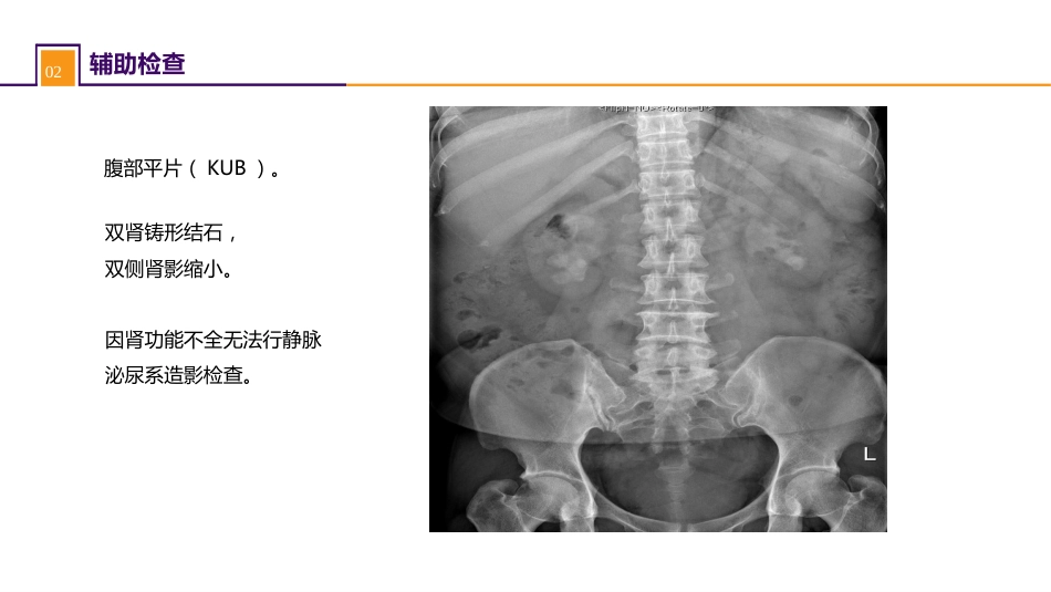 案例分析-双肾结石并慢性肾功能不全_第4页