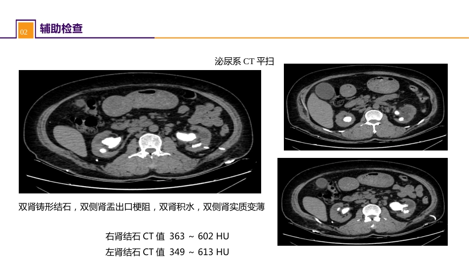 案例分析-双肾结石并慢性肾功能不全_第5页