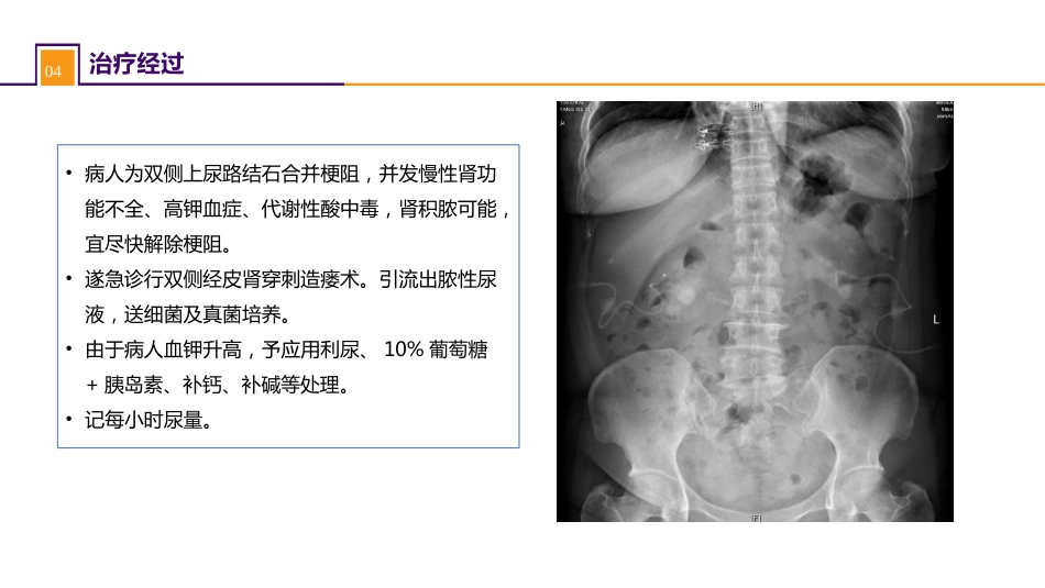 案例分析-双肾结石并慢性肾功能不全_第7页