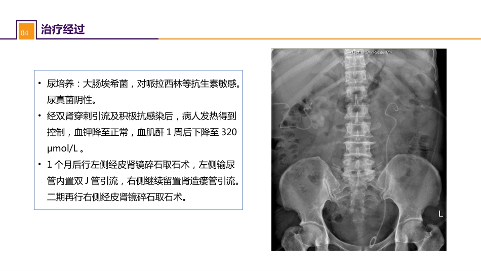 案例分析-双肾结石并慢性肾功能不全_第8页