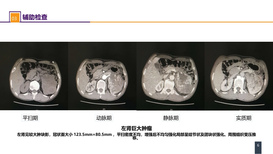 泌尿、男生殖系统肿瘤 案例分析-肾癌_第6页