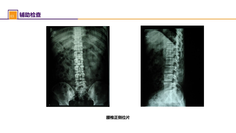 颈、腰椎退行性疾病 案例分析-腰椎间盘突出症_第6页