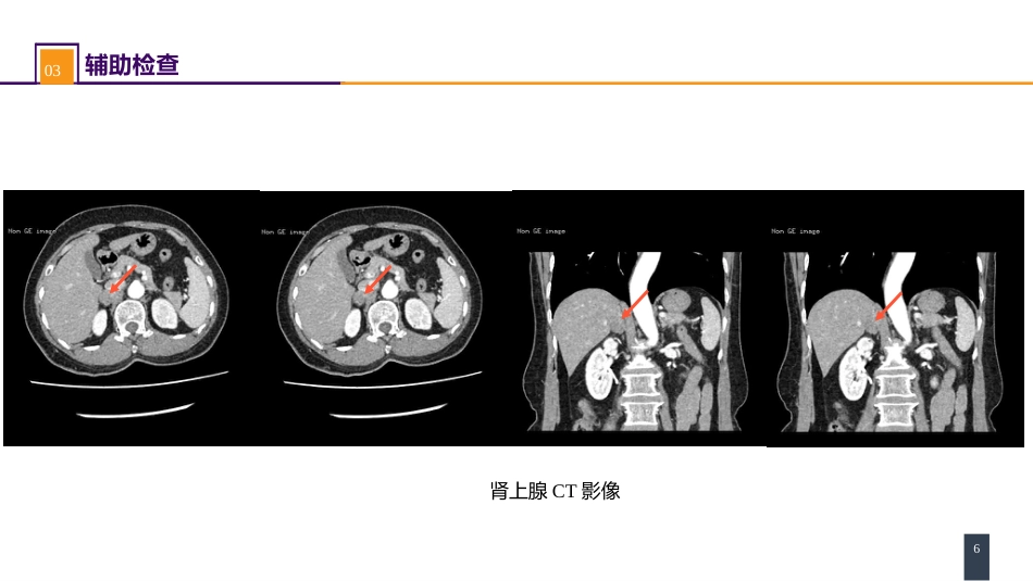 案例分析-原发性醛固酮增多症_第6页