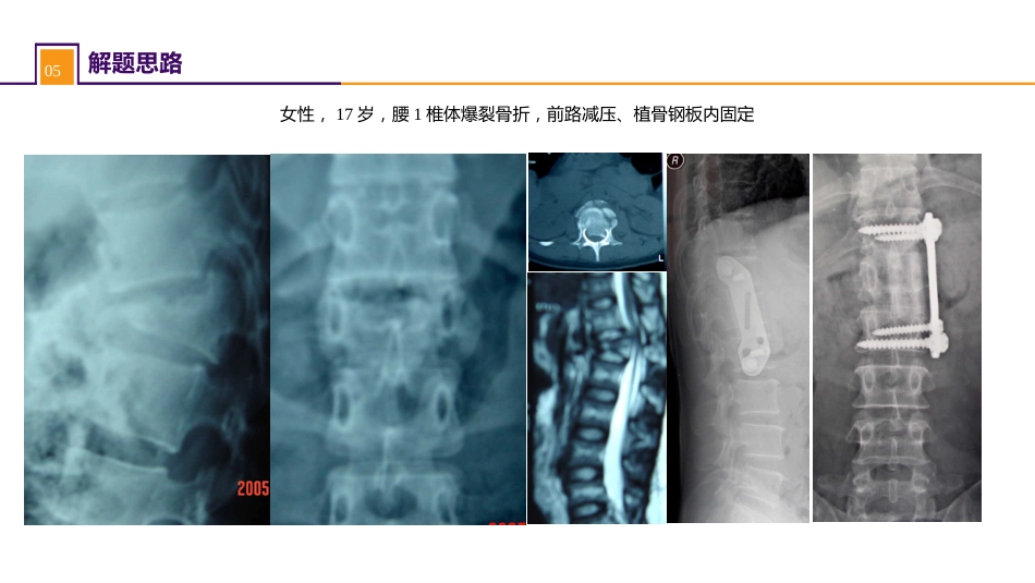 案例分析-腰椎爆裂骨折_第11页