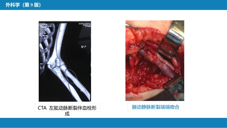 周围血管与淋巴管疾病_第10页
