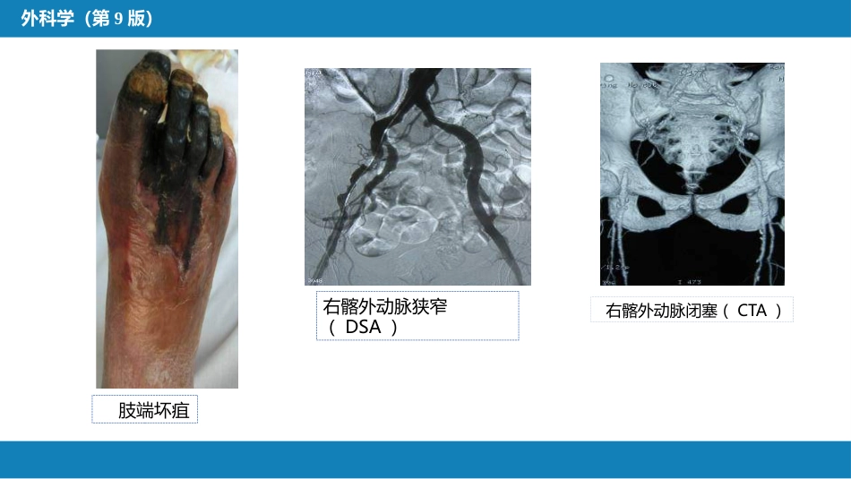 周围血管与淋巴管疾病_第15页