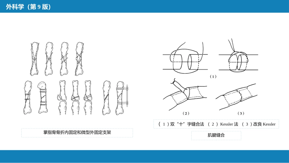 手外伤及断肢（指）再植_第12页