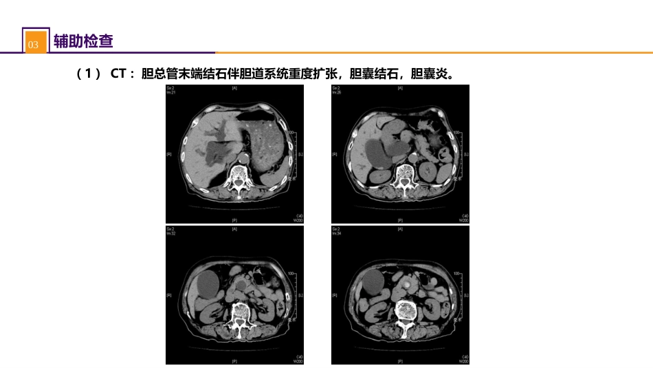 急腹症的诊断与鉴别诊断 案例分析-胆管炎_第5页