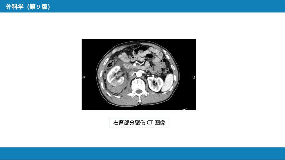 泌尿系统外伤_第6页