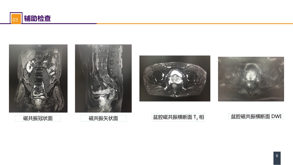 泌尿、男生殖系统肿瘤 案例分析-前列腺癌_第6页