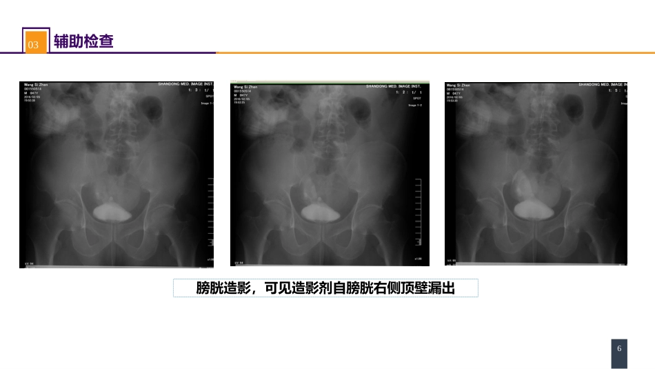 案例分析-膀胱破裂_第6页