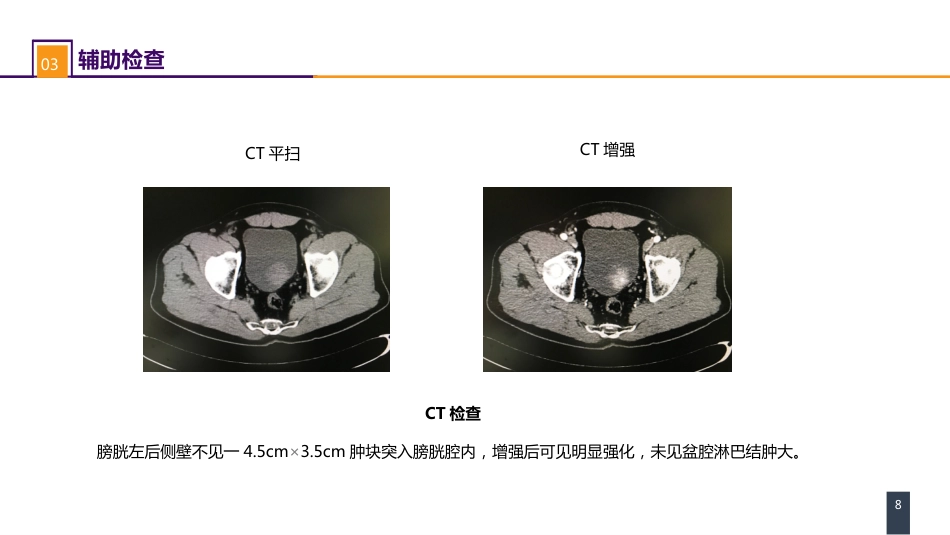 泌尿、男生殖系统肿瘤 案例分析-膀胱癌_第8页