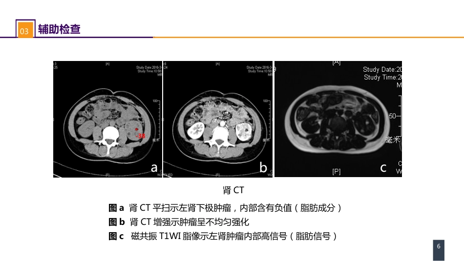 泌尿、男生殖系统肿瘤 案例分析-肾血管平滑肌脂肪瘤_第6页
