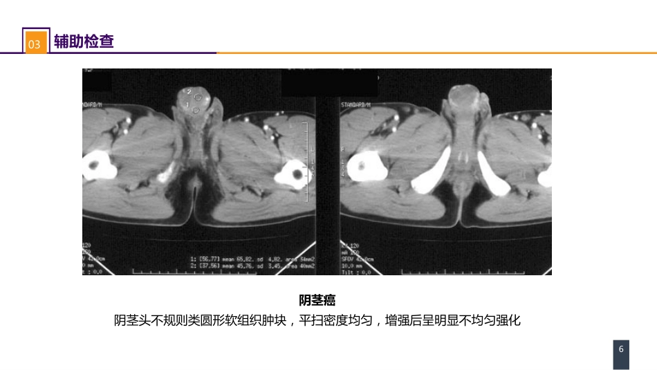 泌尿、男生殖系统肿瘤 案例分析-阴茎癌_第6页