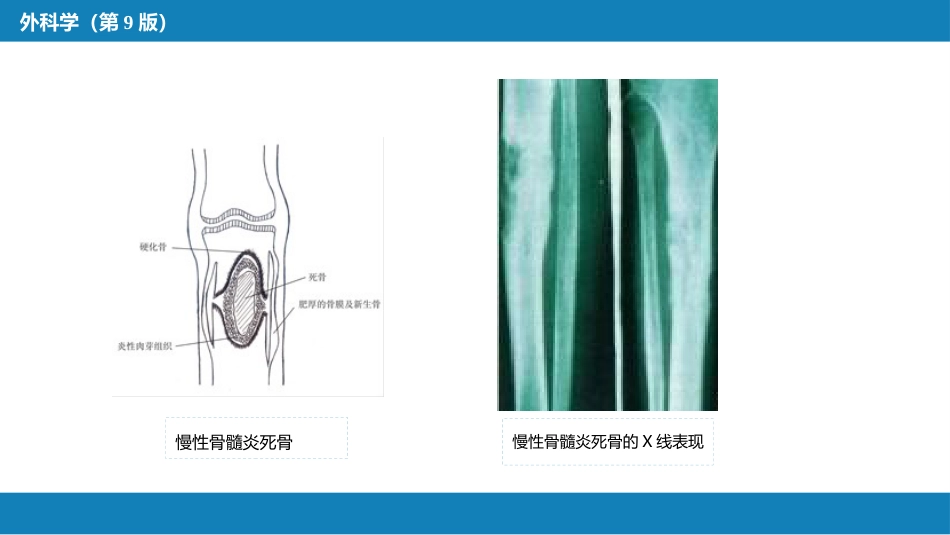 骨与关节化脓性感染_第13页