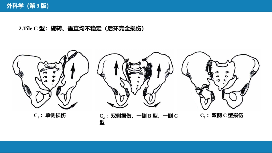 骨盆、髋臼骨折_第13页