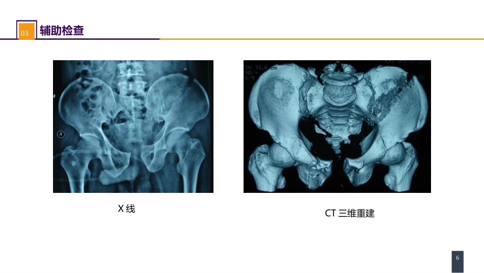 案例分析-骨盆骨折_第6页