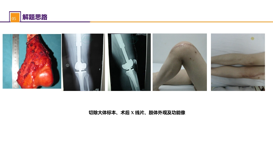 案例分析-骨肿瘤_第11页