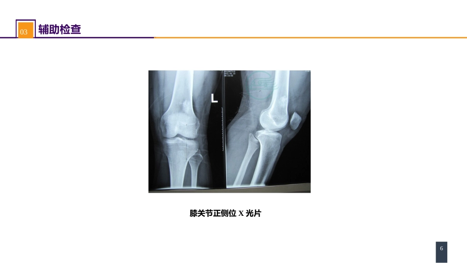 案例分析-骨肿瘤_第6页