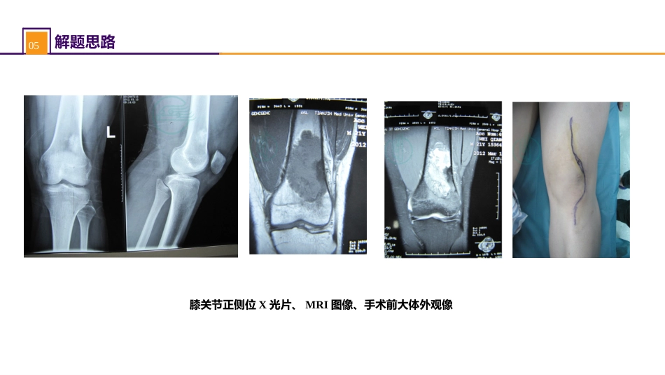 案例分析-骨肿瘤_第9页