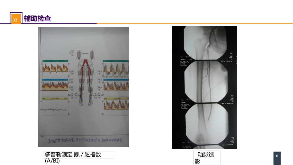 周围血管与淋巴管疾病 案例分析-动脉栓塞_第6页