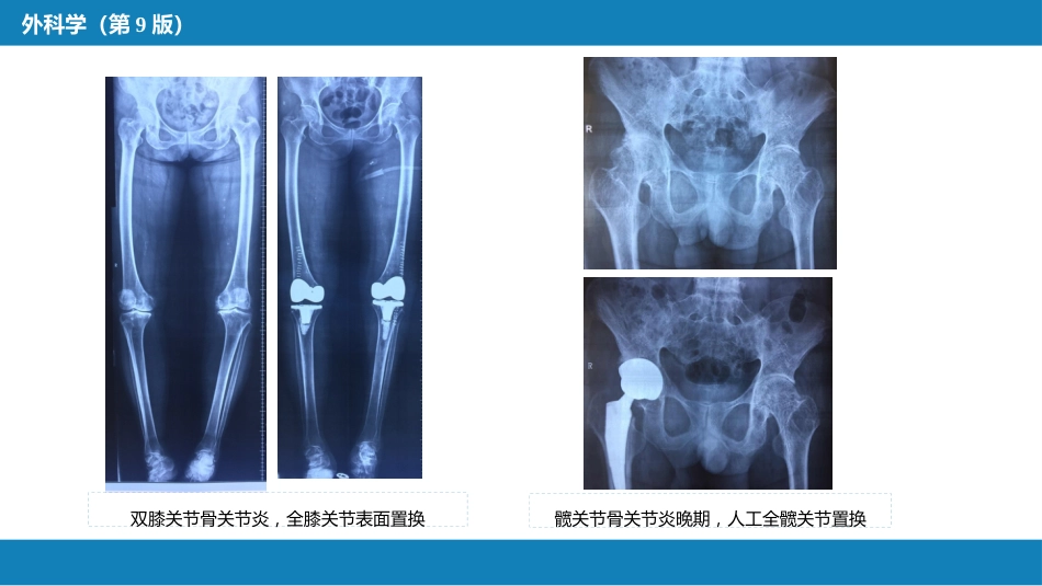 非化脓性关节炎_第13页