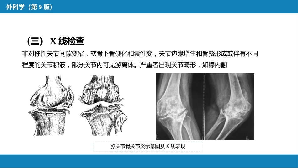 非化脓性关节炎_第9页