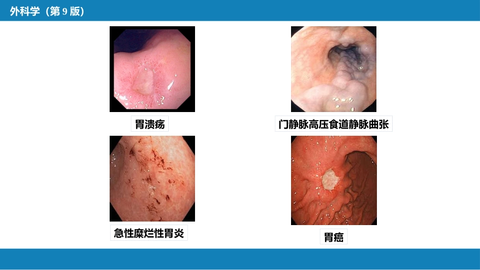消化道大出血的诊断与外科处理原则_第10页