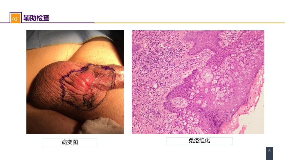 泌尿、男生殖系统肿瘤 案例分析-阴囊Paget病_第6页