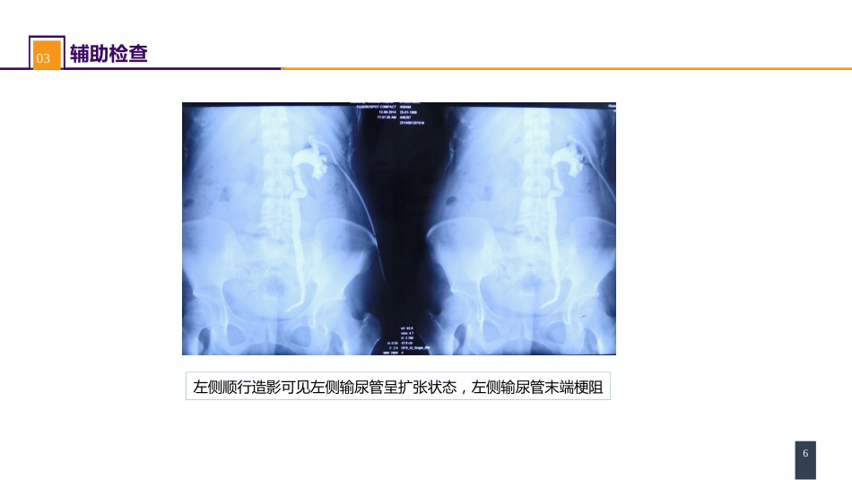 案例分析-输尿管损伤_第6页