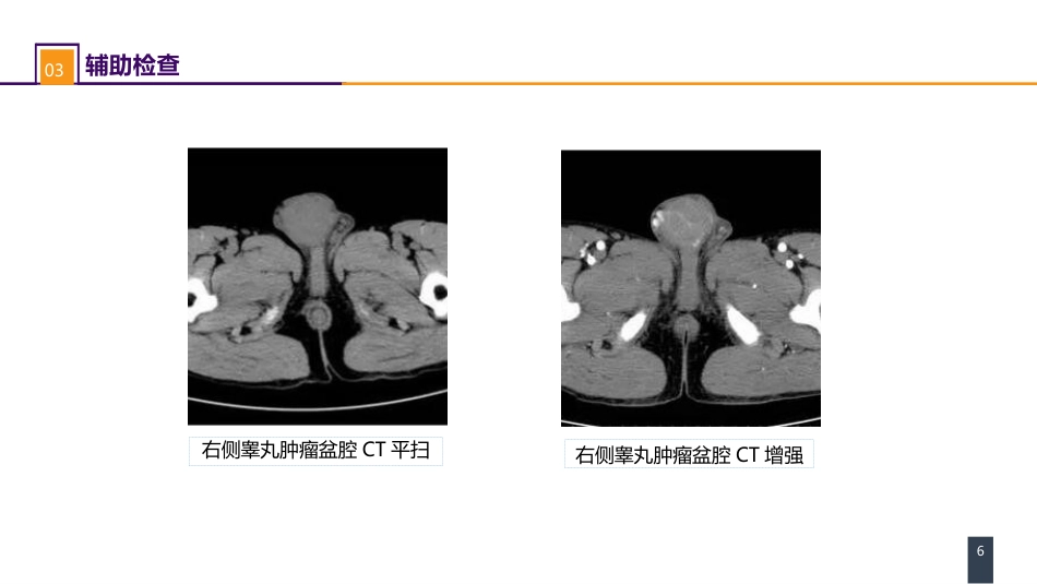 泌尿、男生殖系统肿瘤 案例分析-睾丸肿瘤_第6页