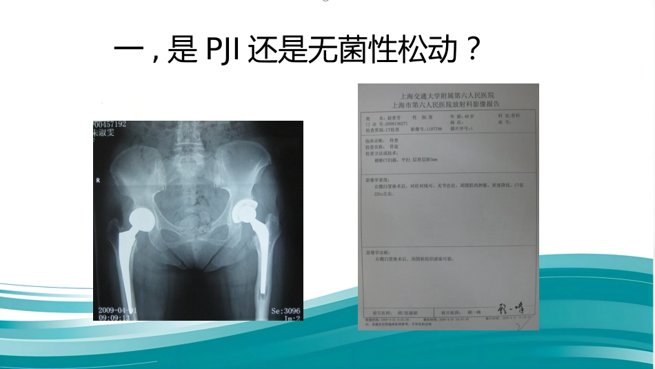 PJI诊断困惑假体周围感染的诊疗_第5页