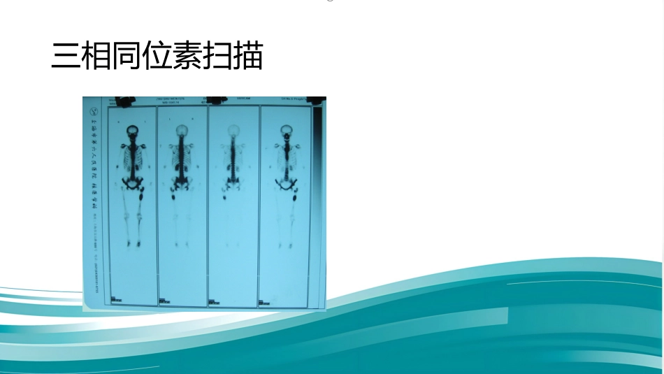 PJI诊断困惑假体周围感染的诊疗_第7页