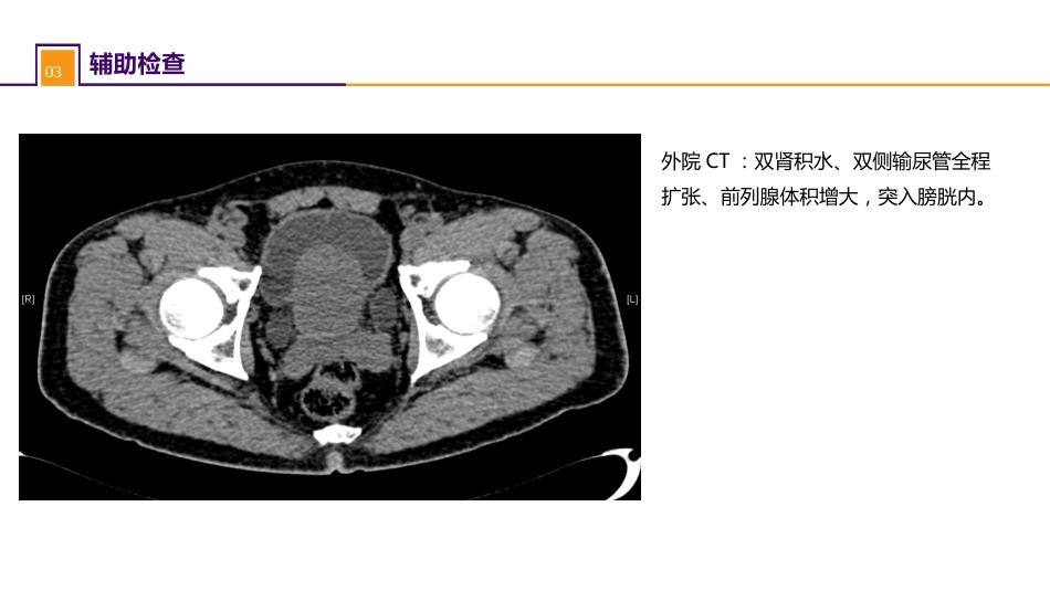 案例分析-前列腺增生症并双肾积水_第7页