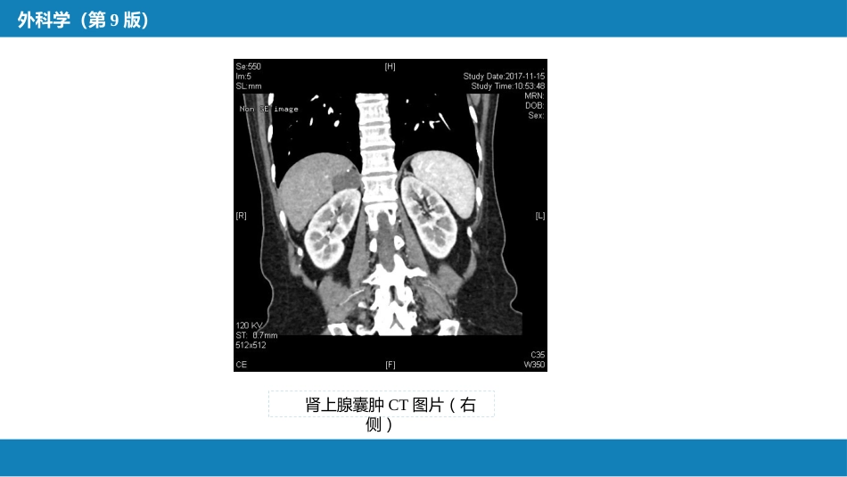 肾上腺疾病的外科治疗_第15页