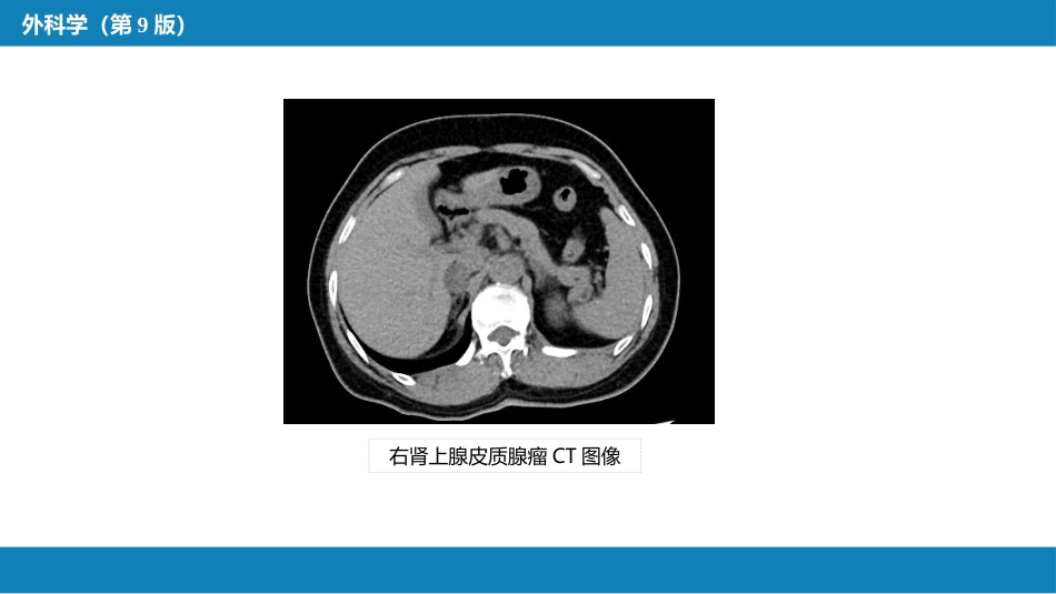 肾上腺疾病的外科治疗_第6页