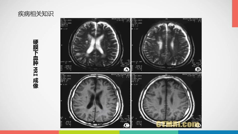 急性硬膜下血肿护理查房_第13页
