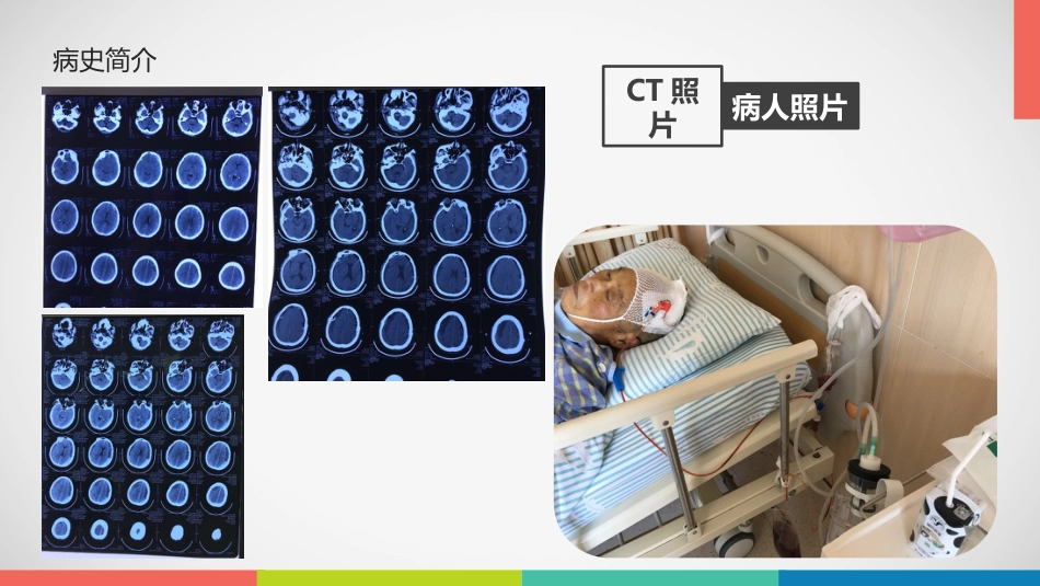 急性硬膜下血肿护理查房_第7页